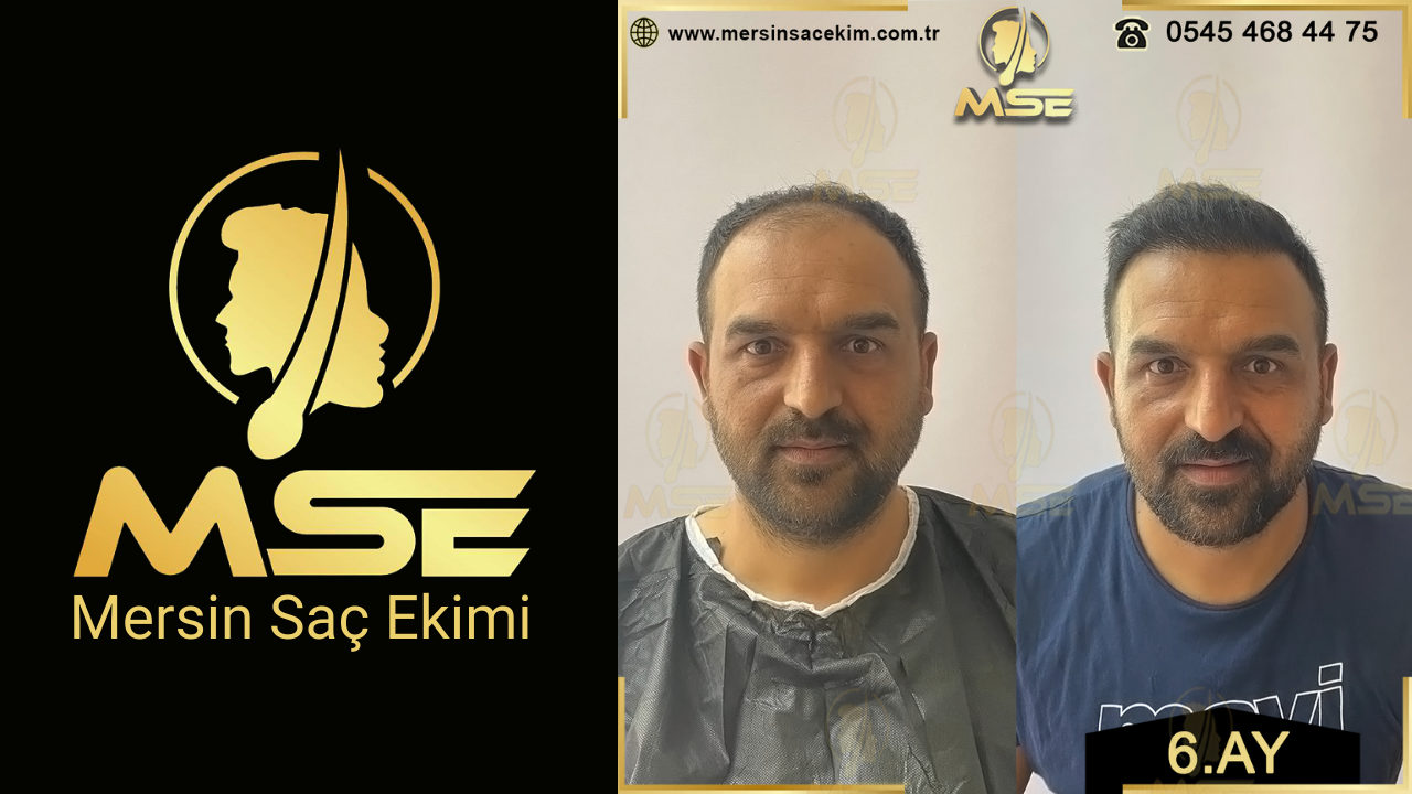 Mersin Saç Ekimi